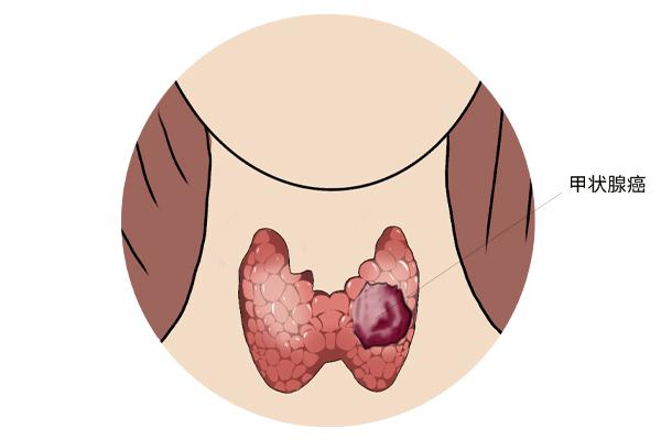 甲狀腺癌癥的主要癥狀表現(xiàn)有什么？為什么會得甲狀腺癌癥呢？